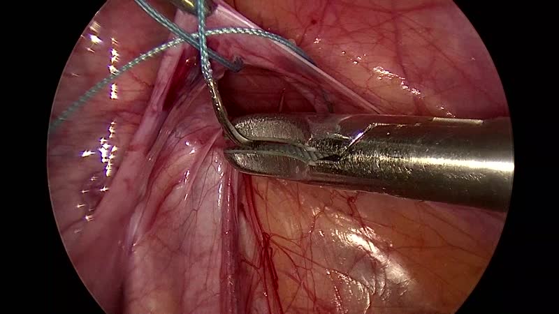 Лапароскопическая герниопластика у мальчика