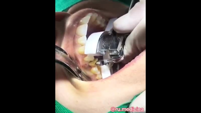 Как вам такой метод удаление зуба? 😊