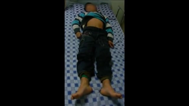 Хорея сиденгама ревматическая хорея малая хорея ревматология педиатрия пляска святого вита танец святого вита