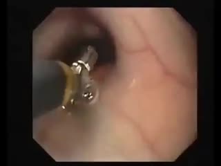 Инородное тело пищевода