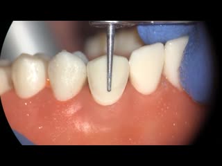 Veneer preparation type 1, stage 2 live from module 3