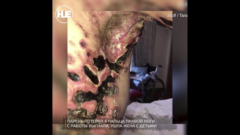 В новой зеландии парень едва не молодые от опасной инфекции