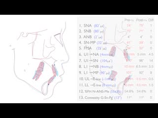 Chris of fuctional shift and blocked in lateral incisors with aligners ортодонтия