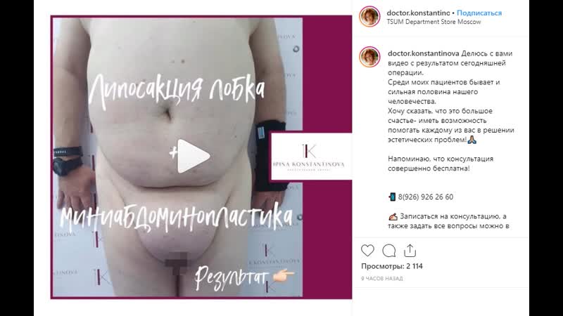 Липосакция лобка и абдоминопластика