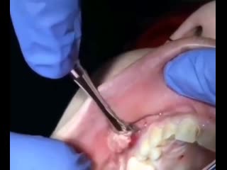 Поднадкостничный абсцесс (периостит) верхней челюсти