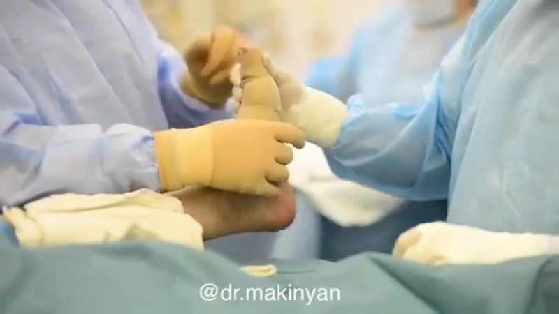 Молоткообразная деформация пальцев является одной из наиболее часто встречаемых форм среди всех вариаций деформаций стоп