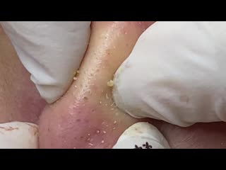 Угри на щеках и носу