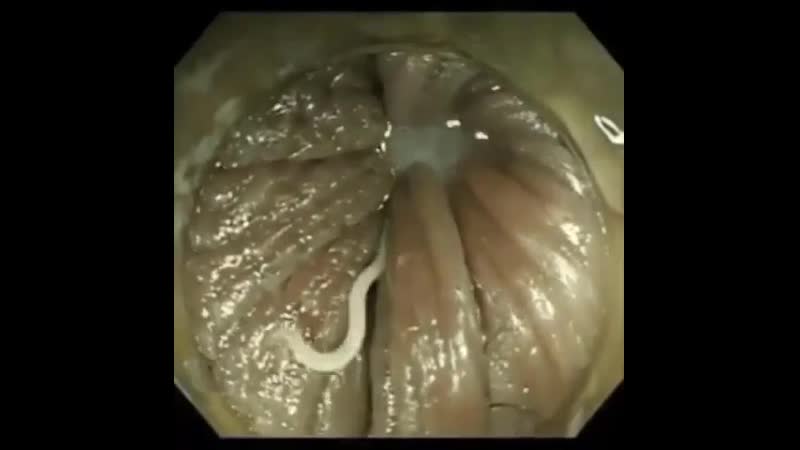 Пациентка прошла колоноскопию, в результате которой был обнаружен червь