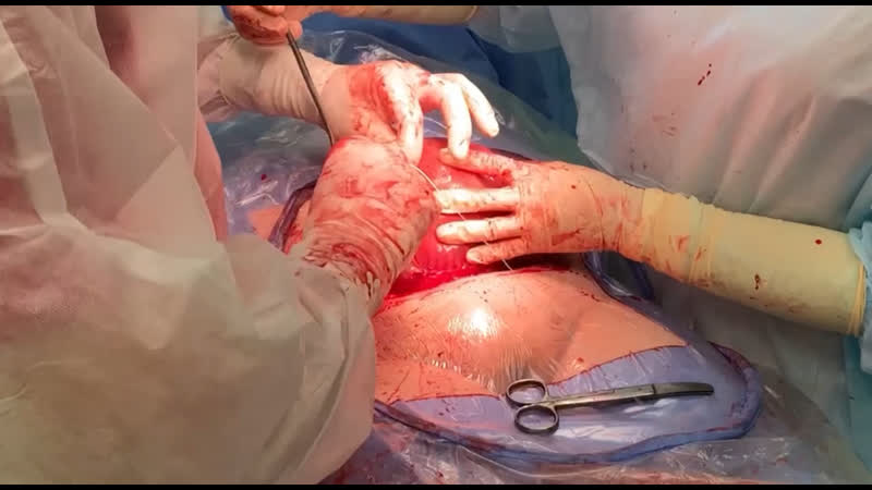 Хирургическая стерилизация или перевязка маточных труб