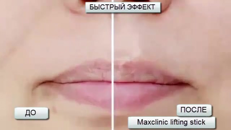 Max clinic cirmage lifting stick
