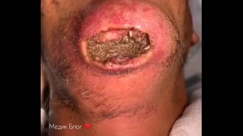 Пациент обратился в приемное отделение с жалобами на инфицированную рану подбородка