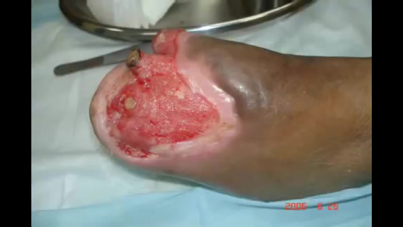 Гангрена ступни при сахарном диабете