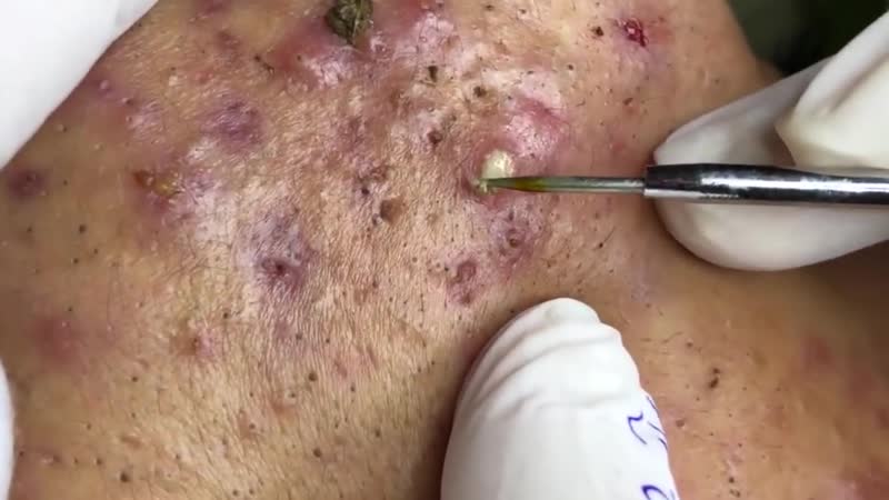 Воспаленные прыщи, корочки