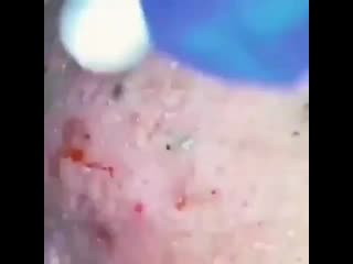 Pimple big byfcglcge0t mp4