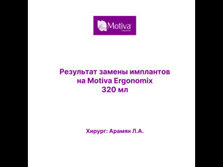 Результат замены имплантов на motiva объемом 320 мл