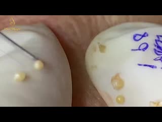 "жемчужное" акне часть 1 из 4