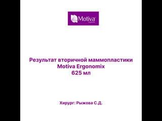 Результат вторичной маммопластики с motiva ergonomix 625 мл