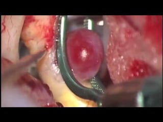 29 клипирование неразорвавшейся аневризмы внутренней сонной артерии