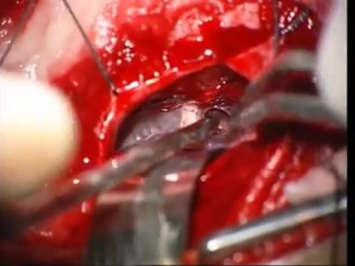 Микроваскулярная декомпрессия тройничного нерва (2)