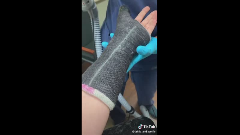 Просто пришла снять гипс