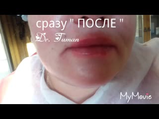 Аугментация губ естественный объем dr tuman zlata