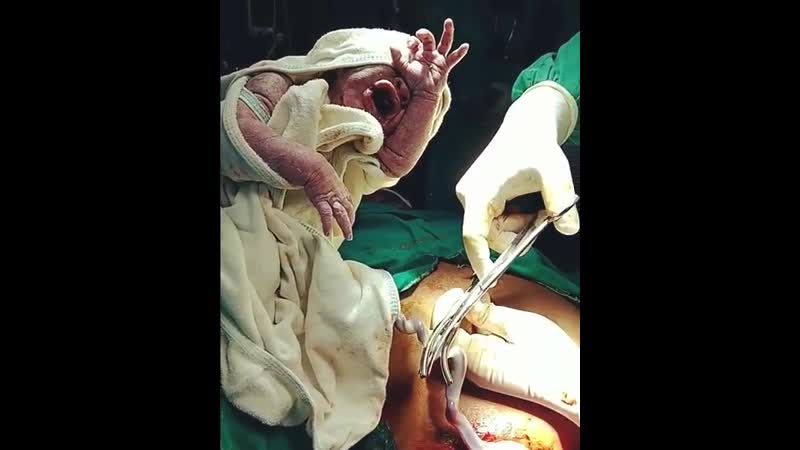 Зажим пуповины