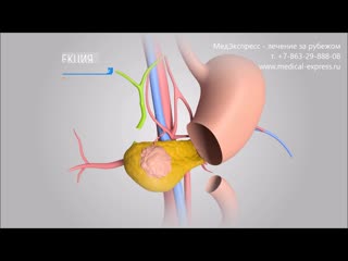 Хирургическое лечение рака поджелудочной железы в германии медэкспресс лечение за рубежом