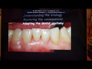 Dental anatomy and porcelain laminate veneers