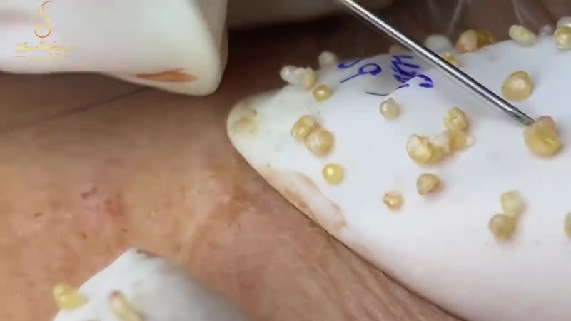 "жемчужное" акне часть 3 из 4