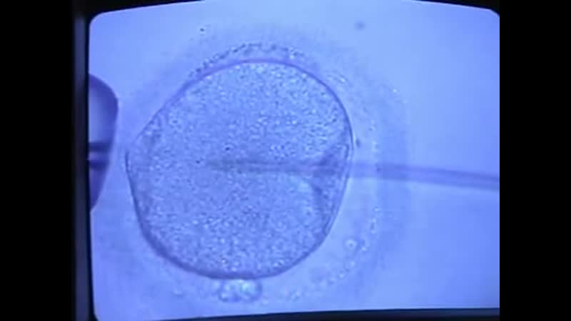 In vitro fertilization (ivf) procedure (part 3)