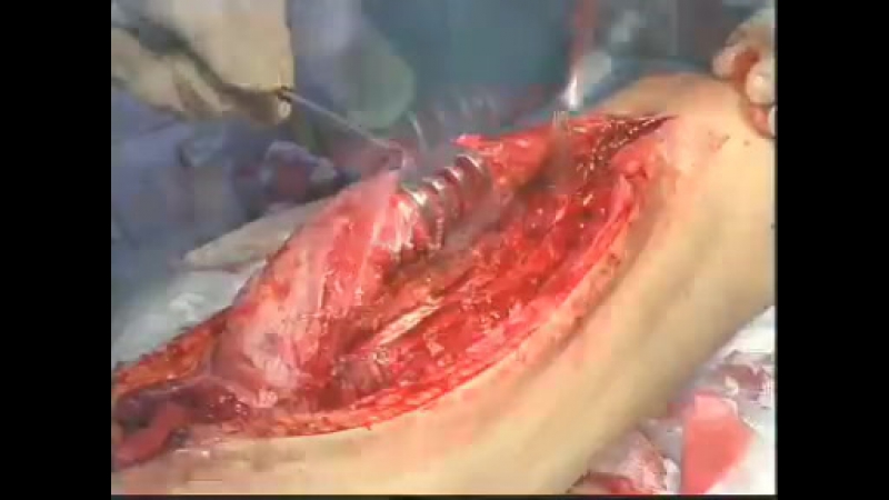 Остеомиелит бедренной кости (osteomielit femur) [360]