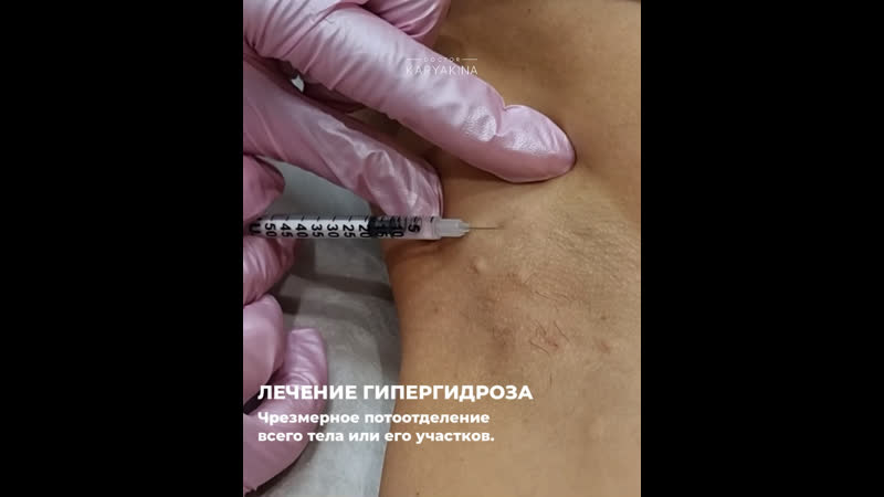 Лечение гипергидроза
