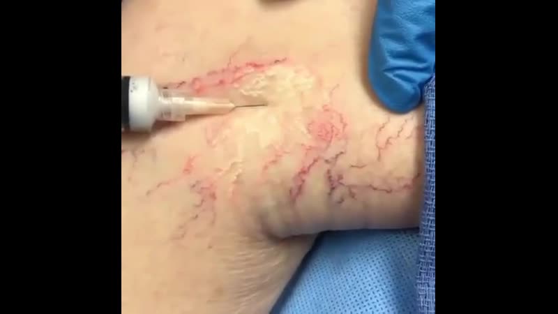 Склеротерапия варикозных вен 💥
