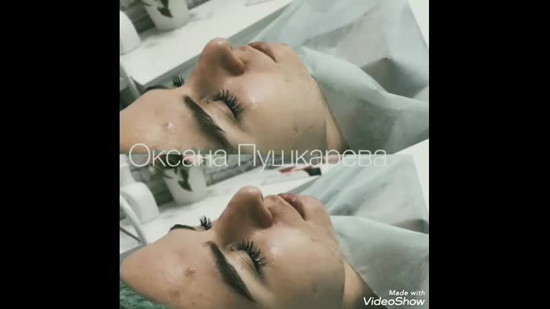 Фракционная мезотерапия bliss