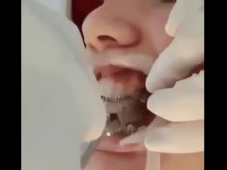 Момент, которого ждут все, кто носит брекеты