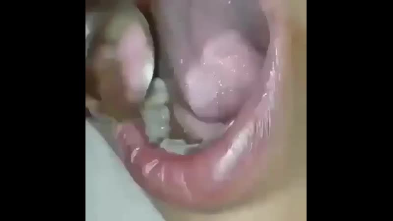 Удаление швов в полости рта