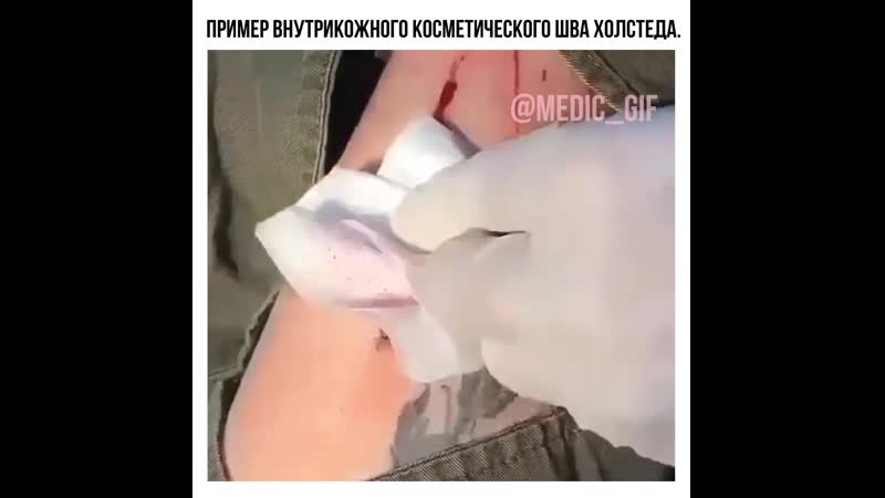 Пример внутрикожного косметического шва холстеда