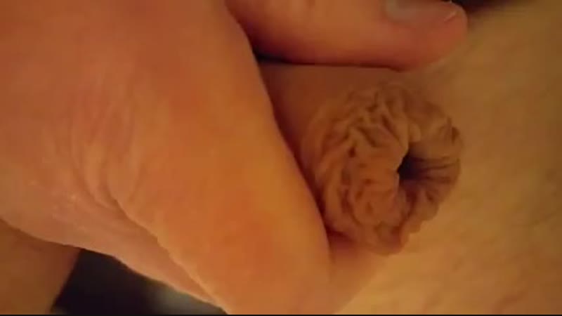 Retracting restored foreskin yeni derisini geri cekiyor