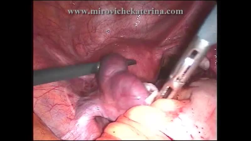 Внематочная беременность(ectopic pregnancy)