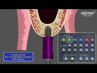 Hiossen osstem cas kit [crestal approuch sinus lifting kit]