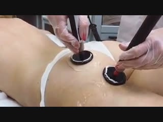 Бразильская попка в mosina clinic