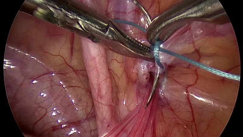 Лапароскопическая герниопластика у девочки