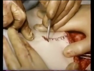 Пластика молочной железы у онкологических больных