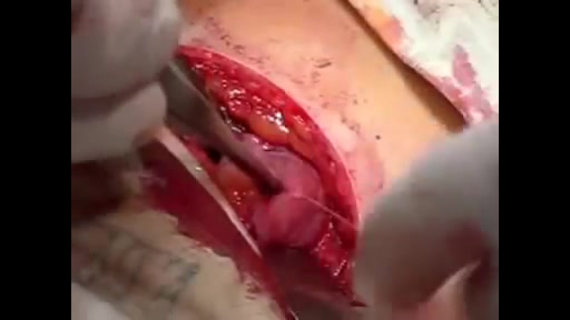 Хирургическое лечение острого аппендицита полный фильм