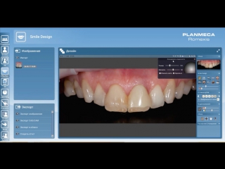 Цифровое планирование эстетического лечения