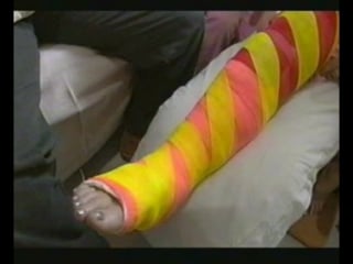 Very bright llc leg cast