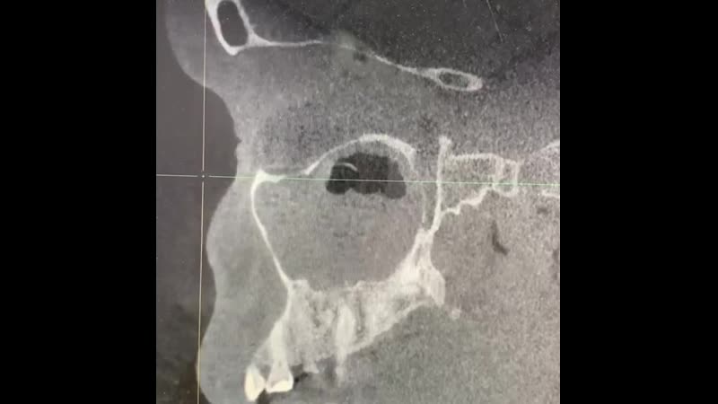 Хронический гайморит 😤