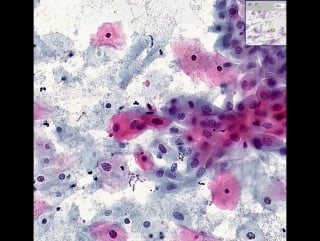 Cervix high grade squamous intraepithelial lesion (hsil), pap smear