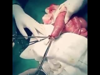 Извлечение аскарид из кишечника