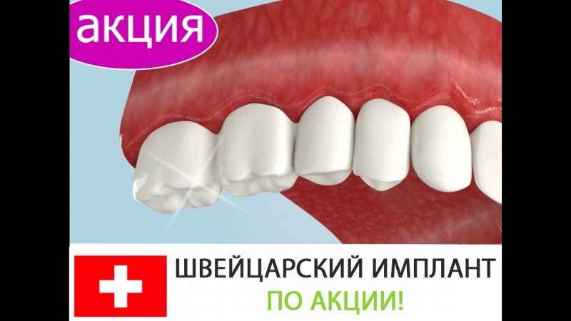 Акция на швейцарский имплант
